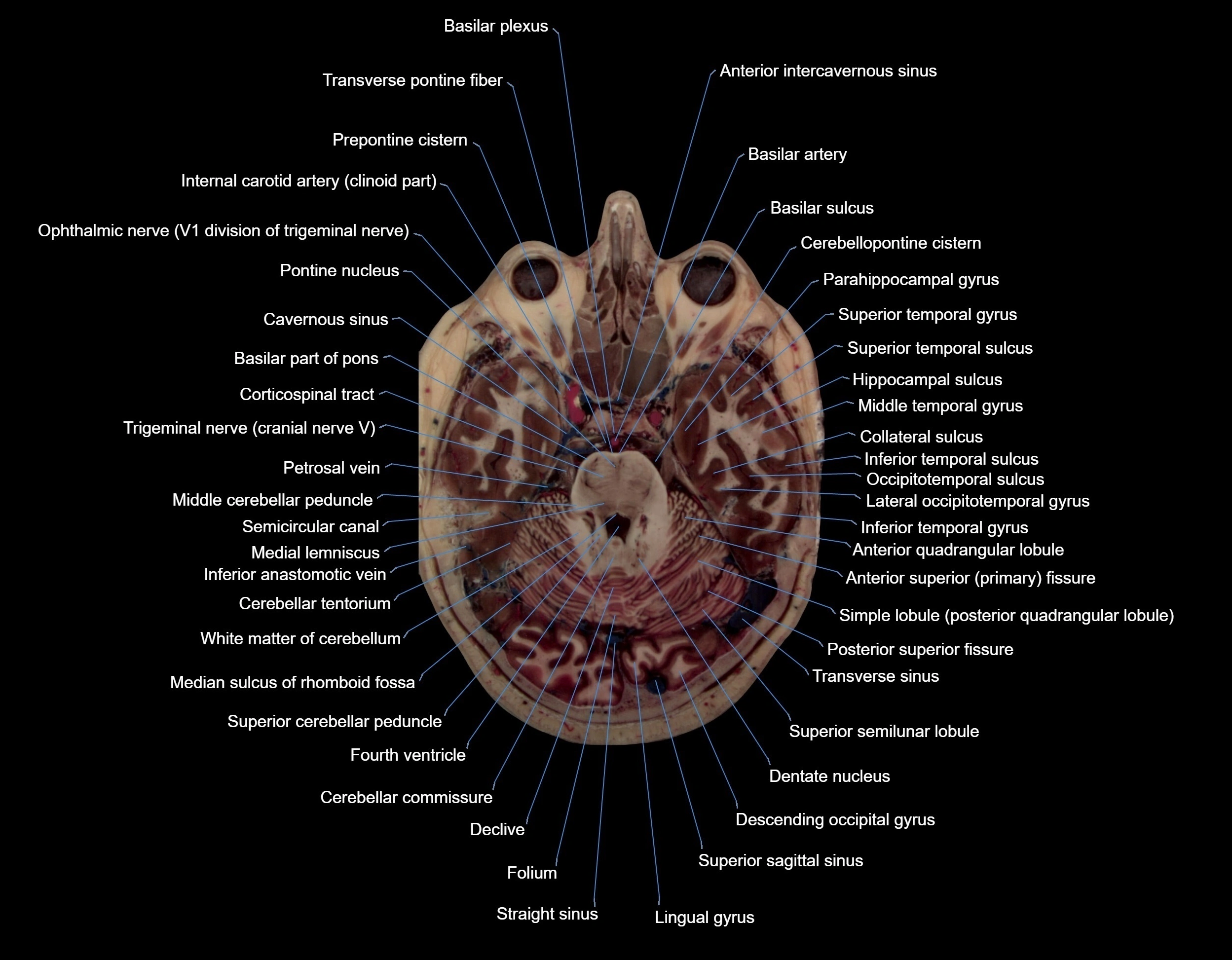 MRI Brain axial cross sectional radiology anatomy 3T image  -img-000025.webp
